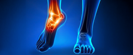 Achilles Tendinitis: What It Is, Why It Hurts, and How g-defy Can Help